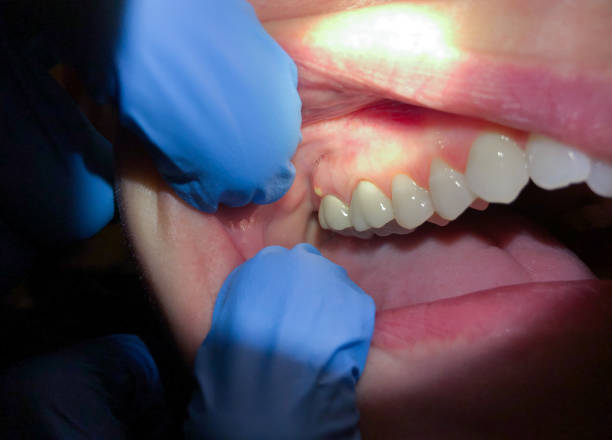 Best Emergency Dental Care for Abscessed Tooth in Palmyra, NJ